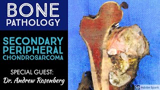 Secondary Peripheral Chondrosarcoma from OsteochondromaExostosis Bone Pathology with Dr Rosenberg [upl. by Enirolf]