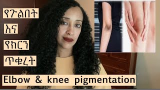 የጉልበት እና የክርን ጥቁረት knee and Elbow pigmentation [upl. by Ahsatan]