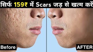 Acne Scars के 3 Treatment  How To Remove Pimples Holes Scars Hindi [upl. by Ocsecnarf643]