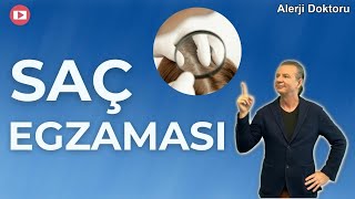 Saç Egzaması Nedir  Prof Dr Ahmet Akçay [upl. by Nodnal]