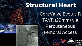 CoreValve EvolutR TAVR 29mm via Percutaneous Femoral Access Structural Heart  August 23 2016 [upl. by Giustina]