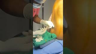 Spinal Anesthesia doctor childbirth hospital postdelivery backpainrelief medicalstudent [upl. by Tomaso]