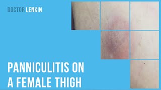 🦵 Panniculitis on a female thigh [upl. by Katherina]