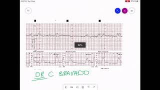 CARDIOTOCOGRAPHY  CTG INTERPRETATION [upl. by Irianat765]