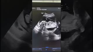 Anencephaly ultrasound anomalyscan [upl. by Konstantine381]