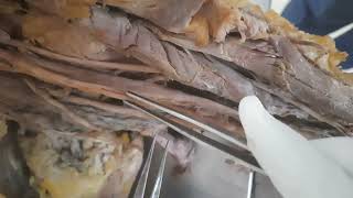 MEDIAN NERVE ANATOMYUPPER LIMB ANATOMYKANCHAN DISSECTION CLASSES [upl. by Atiuqad]