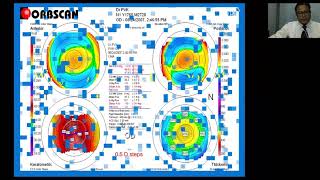 Interpretation of Corneal Topography [upl. by Ahsya2]