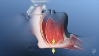 Obesity Hypoventilation Syndrome  Mayo Clinic [upl. by Zug186]