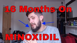 Minoxidil Beard Growth Results  Month 16 on Minox for the Beard  TheJourneyContinues [upl. by Demona]