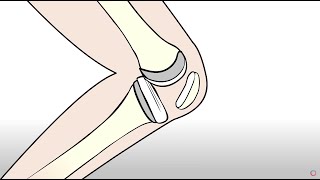 Knee Replacement vs Regenexx Orthopedic Regenerative Treatment [upl. by Saks694]