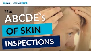 The ABCDEs of Skin Inspections  L’ABCDE des inspections de la peau  SickKids [upl. by Siari]