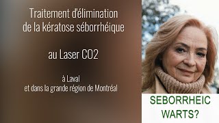 Traitement délimination de la kératose séborrhéique à Laval et dans la grande région de Montréal [upl. by Russian972]