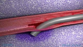 Peripheral IV Infiltration Animation [upl. by Lucine545]