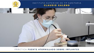 Puente atornillado sobre implantes  Prótesis Dentales [upl. by Raphaela]