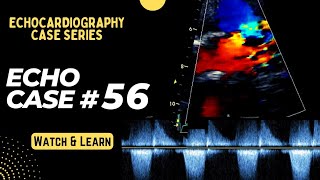 Echo Case 56 Echocardiography Spot Diagnosis Series  Cardiology  Educational Video [upl. by Ticknor]