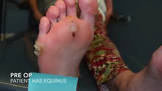 Wound Care The Role of Podiatrist [upl. by Eneluqcaj]