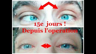 Operation du StrabismeResultat 15 jours apres Une vie normal mattend enfin strabismus operation [upl. by Akenor919]