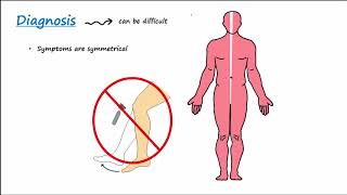 GuillainBarre Syndrome GBS Described Concisely [upl. by Atelokin]