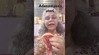 Adenomyosis of uterus health इनफॉर्मेशन [upl. by Neladgam396]