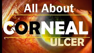 Corneal Ulcer Bengali [upl. by Kcirredal]