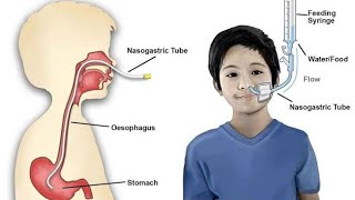 Nasogastric Tube  Levin Tube  Salem Sump tube  Dobhoff tube  Uses indications contraindication [upl. by Adlaremse]