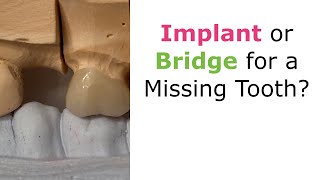 Implant or Bridge for a Missing Tooth [upl. by Agee]