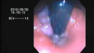 internal hemorrhoids BY DR NASEEM GHOURI [upl. by Halas849]