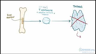 Digeorge Syndrome Osmosis [upl. by Corabel159]