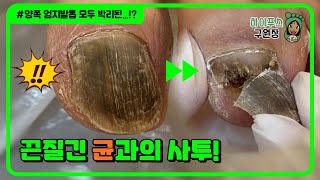 속이 찐득진뜩한 발톱 박리된 발톱을 걷어내니 텅텅빈 모습이 양쪽 발 모두 athletes foot  footcare [upl. by Nosneh]