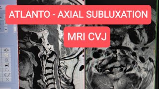 MRI CV Junction  Atlanto axial subluxation  dislocation [upl. by Odraude]