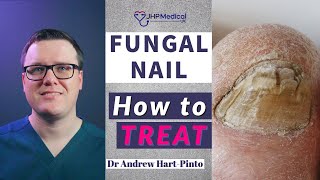 How to TREAT Fungal Nail  Get Rid Of Nail Fungus AntiFungal Lacquer amp Tablets [upl. by Imas]