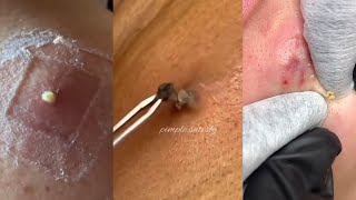 41 Minutes Of Top ASMR Pimple Popping Video [upl. by Solotsopa]