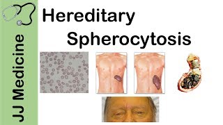 Hereditary Spherocytosis  Pathophysiology Symptoms Diagnosis and Treatment [upl. by Henrion]