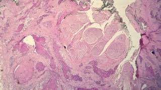 Squamous Cell Carcinoma Keratinizing Type Moderately Differentiated [upl. by Kirstin530]