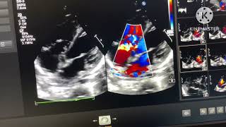 PM VSD with Gerbode Defect [upl. by Kerad]