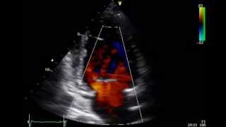 ECHO LEARNING GUIDE COMPLETE ECHOCARDIOGRAM DOPPLER ULTRASOUND [upl. by Ahtelat]