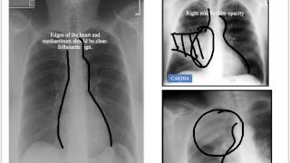 Structured Interpretation of Chest Xray [upl. by Anihsak]