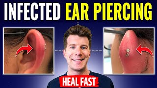 Doctor explains HOW TO RECOGNIZE AND TREAT INFECTED EAR PIERCING [upl. by Hiasi]