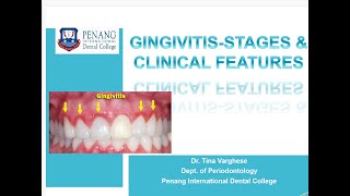 GINGIVITIS STAGES amp CLINICAL FEATURES [upl. by Ditter181]