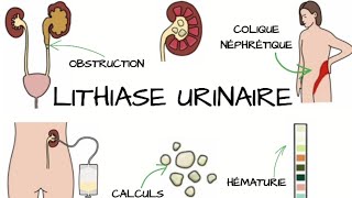 LITHIASE URINAIRE Signes et Symptômes diagnostic traitement  Complications [upl. by Tiemroth]