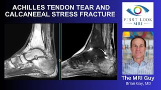 ACHILLES TENDON TEAR AND CALCANEAL STRESS FRACTURE [upl. by Nidnal]