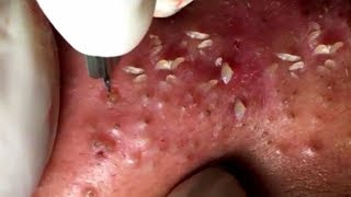 How To Remove Blackheads And Whiteheads On Face Easy 120 ✦ Dr Laelia ✦ [upl. by Hayward]