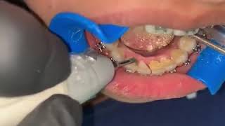 How to Remove Tartar amp Plaque from Teeth [upl. by Marcia]