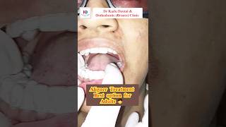 Clear AlignersAligners before and afterAligners cost in IndiaInvisalignytshortsshorts trending [upl. by Azar]