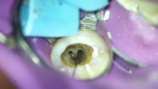 C Shaped root canal system ❤️ [upl. by Marthena]