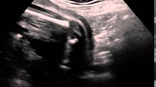 Ultrasound in Obstetrics amp Gynecology A Practical Approach  Clip 32 [upl. by Schram]