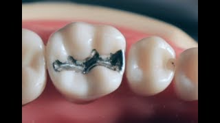 Class II amalgam cavity preparation and restoration [upl. by Meadow]