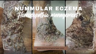 Nummular eczema [upl. by Castro]