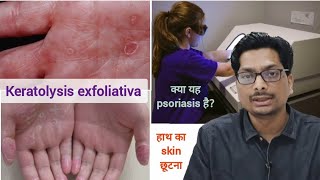 हाथ का skin छूटना  क्या यह psoriasis है Keratolysis exfoliativa  Peeling of hand skin psoriasis [upl. by Lleuqram]