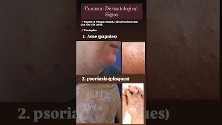 Dermatological signs papules acne acnetreatment psoriasis plaques [upl. by Licastro540]